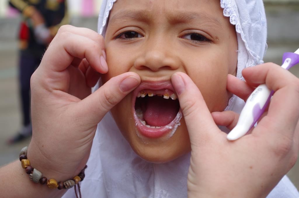 Figur 1: Indonesisk jente med store kariesangrep på fortennene, får opplæring i pusseteknikk. Høgskolestudent, kandidatnummer 23, 2016. Brukt med tillatelse.