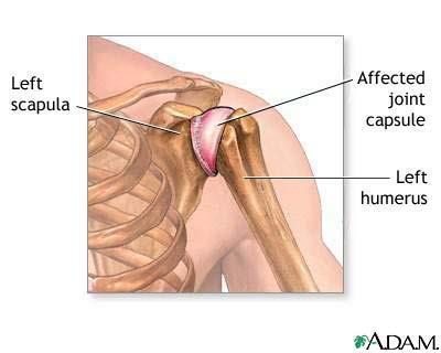 Frozen shoulder - Skulderkapsulitt Skulderkapsulitt er en betennelse i leddhinnen som omgir skulderleddet.