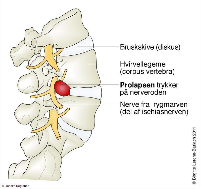 Isjias - Lumbale nerverotsmerter Lumbale nerverotsmerter skyldes påvirkning av nerverøttene i columna lumbalis.