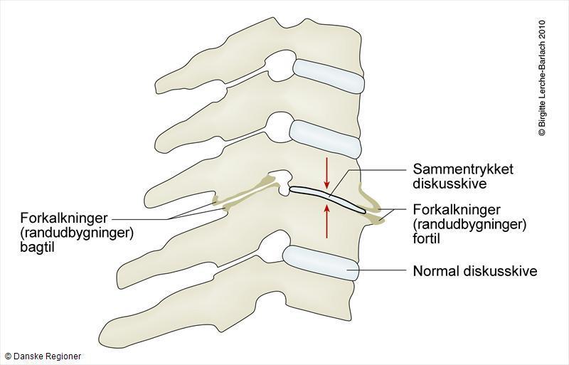 Spondylose Spondylose er degenerative forandringer (slitasje) i ryggraden. Dette kan føre til at det dannes forkalkninger mellom ryggvirvlene og medføre redusert bevegelighet.