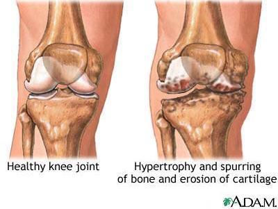 Artrose Kneleddet består av lårbenets og leggbenets leddflater. Artrose (slitasjegikt) i kneleddet er slitasjeforandringer i leddbrusk eller ben i kneleddet.