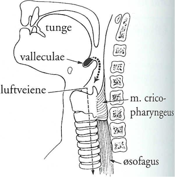 Svelgvanskar 2 Sinus piriformes Forseinka eller manglande svelgrefleks Mat og væske glir ned i svelget