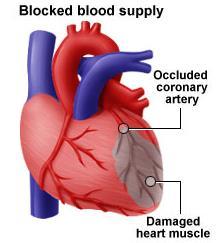 Hjertebeskyttende medisiner: Betablokker Nitroglycerin Kirurgisk: PCI (utblokking), bypass Hjerteinfarkt Bind 1 s 40-41 Hjerteinfarkt skyldes en tilstopning av en av hjertets kransarterier