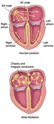 Atrieflimmer Takykardi som oppstår i atriene Aksjonspotensialer brer seg i atriene med en frekvens på over 400/min.