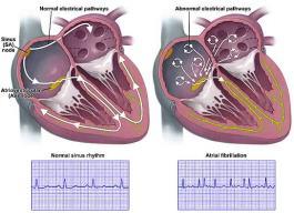 Ventriklene trekker seg derfor sammen med en lavere frekvens (100-150/min) som er uregelmessig. mdguidelines.