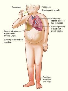 Symptomer på hjertesvikt Symptomer (med årsaker) Tungpust (vann i lungene), særlig ved horisontalt leie og aktivitet Hovne bein (væskeopphopning) Redusert fysisk yteevne og slapphet (redusert