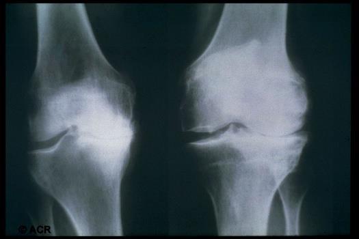osteoarthritis > 60 years: