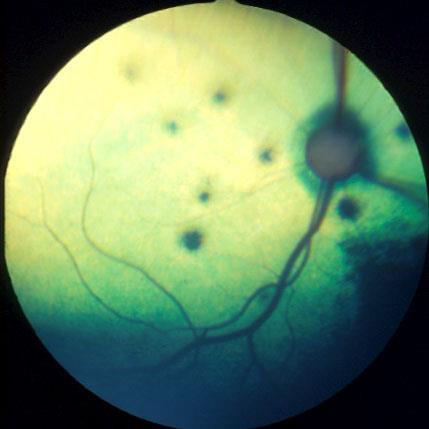 Toxoplasmose øyeforandringer Chorioretinitt Retinal