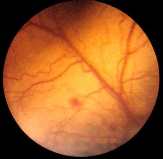 Øyeforandringer Diffust retinaødem