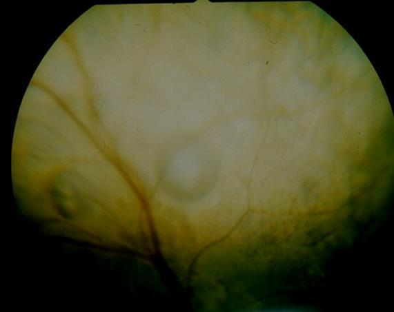 retinalkar Intraretinal blødning Preretinal