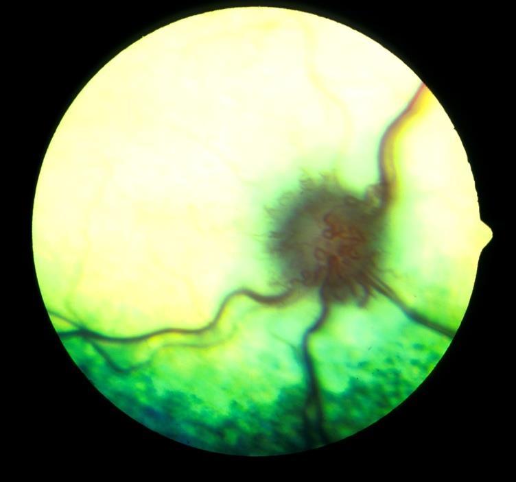 Tiaminmangel-retinopati Foringsbetinget Tiaminaseeffekt Destruksjon av tiamin i fóret under oppvarming