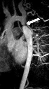 Figur 6 Kontrastforsterket MRA av coarctatio aortae. Selve koarktasjonen sees som en markert innsnevring (pil) på aorta like distalt for avgangen av en vid a. subclavia sinistra.