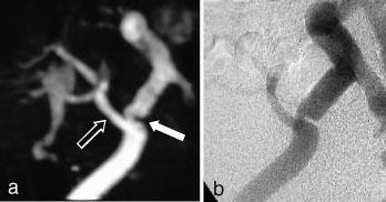 nyttig hos nyre- og levertransplanterte pasienter (19). Ved mistanke om arteriestenose vil metoden kunne selektere de pasienter som bør utredes videre med kateterangiografi før ev.