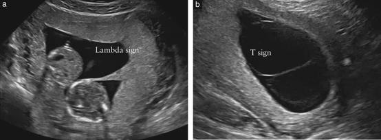 anemia-polycytemia sequence (TAPS) Monoamnionic twins (Antenatal care) (Delivery) Twins zygosity and chorionisity Timeline of zygotic splitting and resulting placentation Dizygotic versus monozygotic