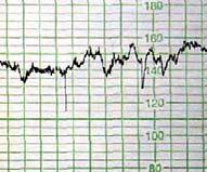 Forløsning uansett kriterier hvis: 1. STV < 2,6 ms (< 29 u) eller < 3 ms (> 29 u) 2.