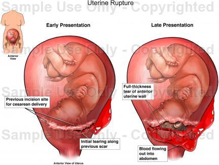 Are infant and maternal outcomes worse following complete rupture in unscarred or scarred uterus? At complete uterine rupture: What is associated with poor infant & maternal outcome?