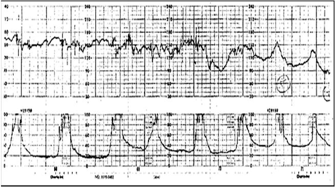 !!!! Diagnosis Fetal Heart changes (decelerations, Bradycardia) = 60 70% Sharp pain between contractions; scar pain Contractions that slow down or become less intense Baby s head moving back up into