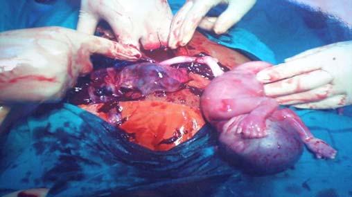 RESULTS: Complete uterine rupture was 0.4/10 000 in unscarred uteri 21.