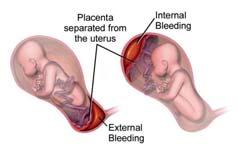Forårsaker maternell og føtal morbiditet og mortalitet Antenatale