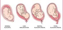 Placenta previa Smertefri vaginalblødning Placenta ligger delvis
