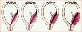 INVASIV PLACENTA Placenta accreta spectrum disorder (PAS) 1:300-1:500 svangerskap: