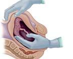(REBOA): intervensjonsradiolog Devaskularisering av uterus ligatur av aa. uterinae/aa.