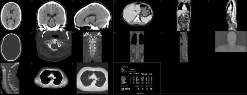 cerebrum hals CT hals thorax CT thorax