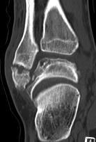 CT- Tumor Ax CT T1