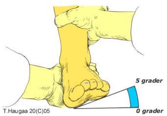 calcaneo-metatarsus eller lig calcaneo - naviculare "springligamentet"). Generelle overbelastninger som følge av nedsatt støtabsorpsjonsapparat og støtdemping.