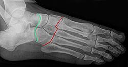 LEDDFRIGJØRING AV CHOPART`S OG LISFRANC LEDDLINJE Om leddforbindelsene: Art. calcaneocuboidea, calcaneus og cuboideum, sammen med naviculare og caput tali danner Chopart's leddet.