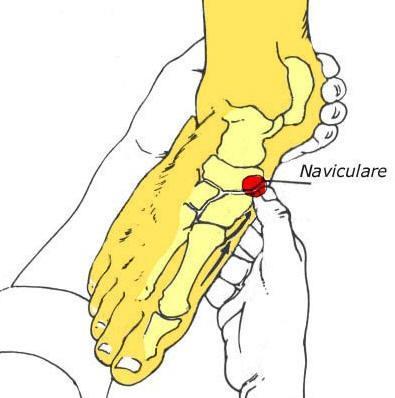 LEDDFRIGJØRING AV OS NAVICULARE Om leddforbindelsen: Os naviculare er en sentral del av støtabsorpsjonsapparatet til kroppen.