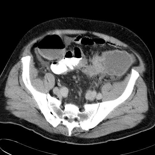 Divertikulitt - Diagnostikk Mistanke om divertikulitt CT med i.v. og oral