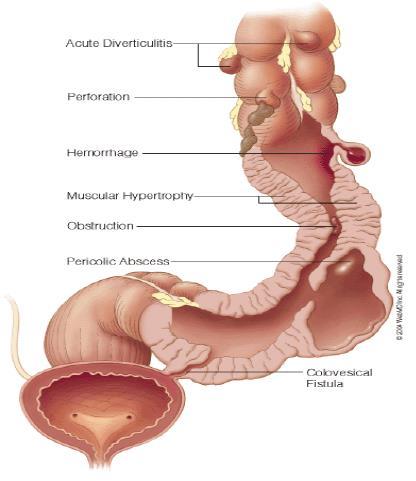 Komplisert divertikulitt Indikasjon for innleggelse Påvirket