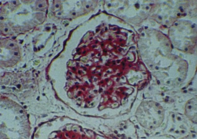 Kasuistikk: 12 år gammel gutt! Sykehistorie: Nyrebiopsi Anuri i 5 måneder! Kreatinin: 83 µmol/l 210 µmol/l Somnolent-komatøs!