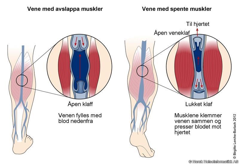 Muskel-venepumpe, forts. Åreknuter Med alderen fungerer klaffene i venene dårligere.