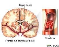 Hjerneslag Ved hjerneslag blokkeres som regel en av blodårene til hjernen, slik at nervecellene ikke får nok oksygen og dør.
