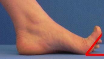Test av dorsalfleksjon av stortåa (Metatarsophalangialleddet) Dorsalfleksjon av stortåa er viktig for flere sentrale funksjoner i foten, slik som: Windlassfunksjonen (meny 5.