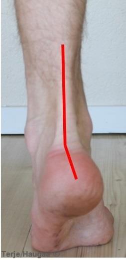 Ved nedsatt bevegelse i dette leddet påvirkes støtdempingen. Test av subtalarleddet venstre fot Fig 5. Normal valgus stående er 5. Det er anatomisk betinget. Fig 6.