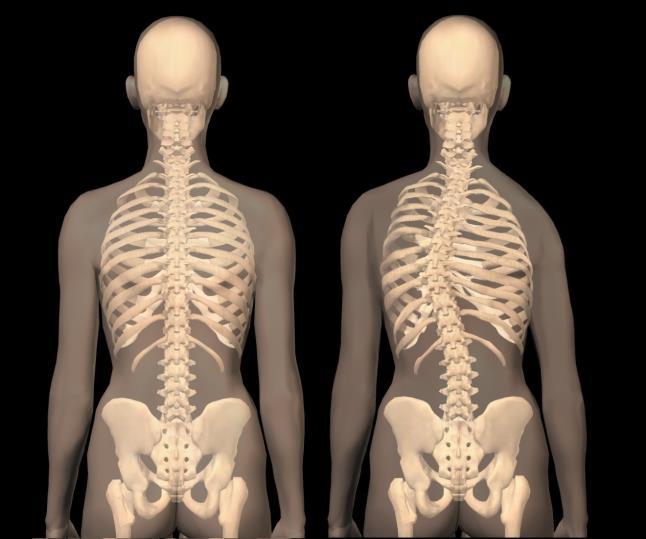 Venstrekonvex thoracal skoliose 27 Ryggradens oppbygning