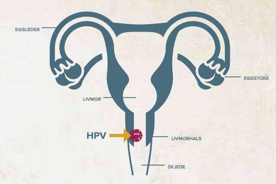 Effekt av Cervarix Dokumentert > 90 % beskyttelse mot alvorlige forstadier til livmorhalskreft uavhengig av HPV-type direkte beskyttelse mot HPV 16/18 høy grad av kryssbeskyttelse mot HPV 31/33/45