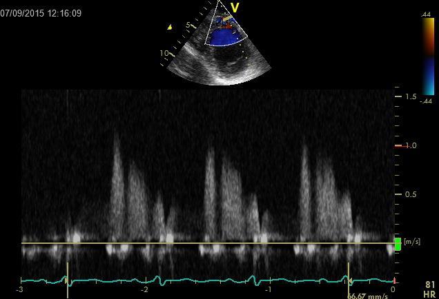 Doppler CFR Måler koronarflow i koronararteriene med