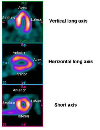 SPECT = single Photon emission CT Fordeler Både fysiologisk og farmakologisk stress Iskemi: perfusjon Prognose vurdering Ulempe Stråling