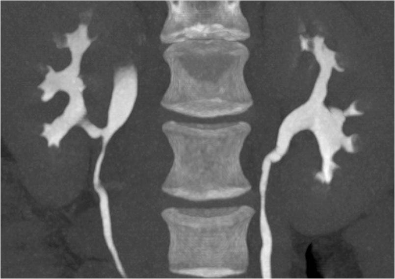 Figur 6 CT lavdose med kontrast i ekskresjonsfase fem måneder etter operasjonen. Bildene er tatt i bukleie, med koronal, kurvet multiplanar rekonstruksjon.