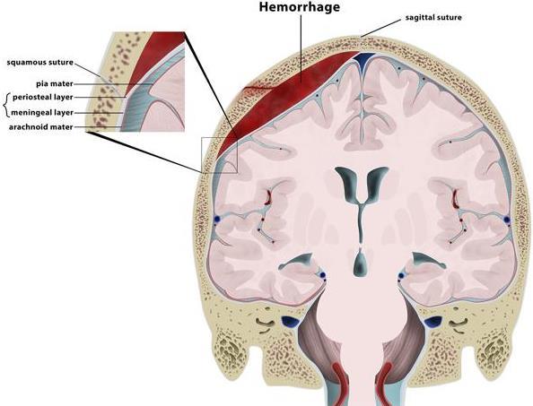 Epiduralhematomer (EDH) 15-25% viser forsinket progresjon Lokalisert mellom kalvariet og dura