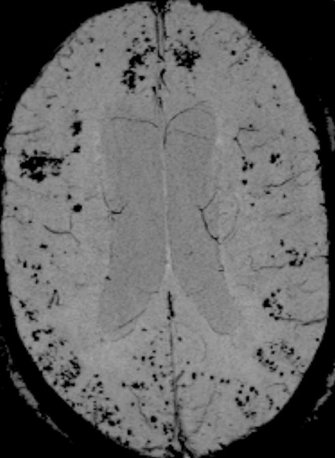 diagnostikken TSE T2 SWI