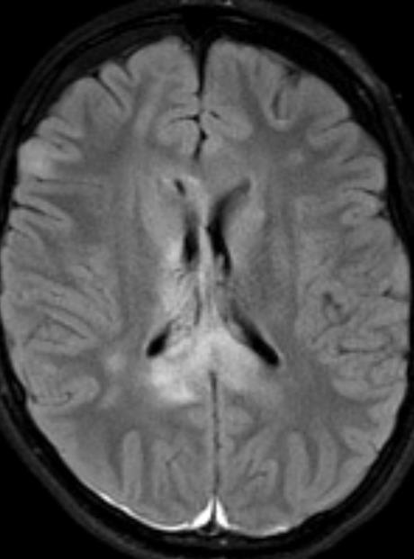frontallapper, corpus callosum og mesencefalon CT