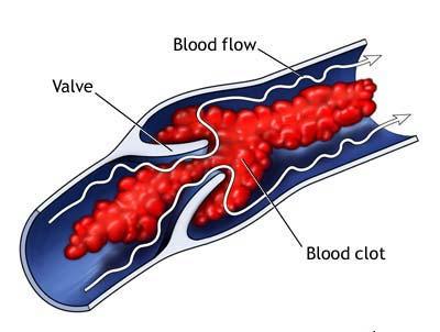 Sykdommer i sirkulasjonssystemet Bind 1 s 11-14 Blodpropp: Trombose og emboli Trombose, emboli og aterosklerose er sentrale sykdomsmekanismer i sirkulasjonssystemet.