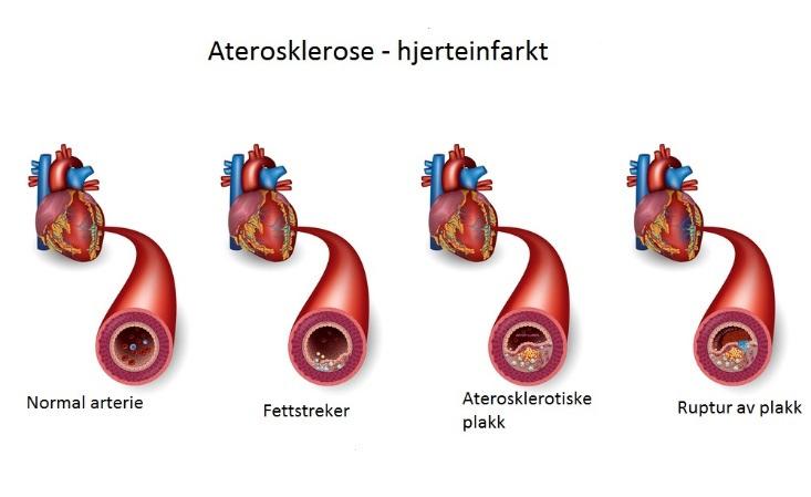 Årsaker Høyt blodkolesterol, spesielt såkalt LDL disponerer for utvikling av aterosklerose, mens såkalt HDL kolestrol motvirker prosessen ved å transportere kolesterol vekk fra arterieveggen.