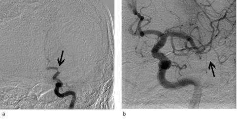 cerebri media (frontbilde) (pil) Ved cerebral angiografi ble det påvist akutt okklusjon av distale del av a.