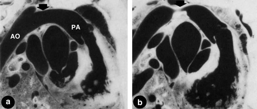 498 T. Kiserud stem. 41 In human fetuses, the arterial supply to the liver is not known but it seems to have a more prominent role during compromise.